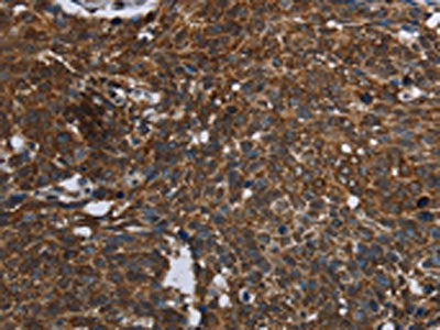 The image on the left is immunohistochemistry of paraffin-embedded Human cervical cancer tissue using FASTKD2 Antibody(FASTKD2 Antibody) at dilution 1/45, on the right is treated with fusion protein. (Original magnification: ×200)Rabbit anti-Human FASTKD2 Polyclonal Antibody