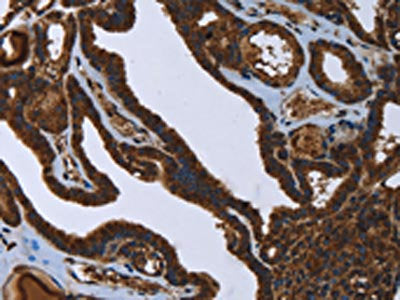 The image on the left is immunohistochemistry of paraffin-embedded Human thyroid cancer tissue using the antibody Antibody) at dilution 1/45, on the right is treated with fusion protein. (Original magnification: ×200)Rabbit anti-Human FASTKD2 Polyclonal Antibody