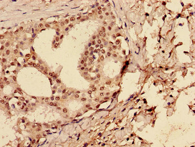 Immunohistochemistry of paraffin-embedded human breast cancer using TP53 Antibody at dilution of 1:100Rabbit anti-Human TP53 Polyclonal Antibody