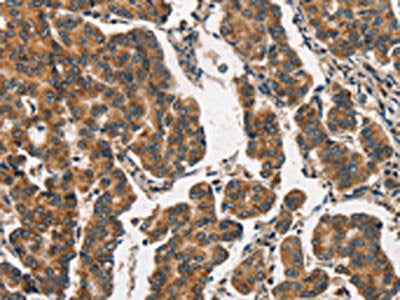 The image on the left is immunohistochemistry of paraffin-embedded Human breast cancer tissue using ITGA2 Antibody(ITGA2 Antibody) at dilution 1/30, on the right is treated with synthetic peptide. (Original magnification: ×200)