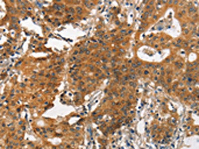 The image on the left is immunohistochemistry of paraffin-embedded Human gastic cancer tissue using the antibody Antibody) at dilution 1/30, on the right is treated with synthetic peptide. (Original magnification: ×200)