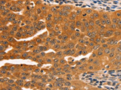 The image on the left is immunohistochemistry of paraffin-embedded Human ovarian cancer tissue using SERPINB5 Antibody(SERPINB5 Antibody) at dilution 1/60, on the right is treated with fusion protein. (Original magnification: ×200)Rabbit anti-Human SERPINB5 Polyclonal Antibody