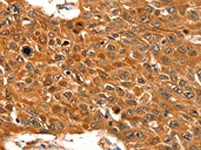 The image on the left is immunohistochemistry of paraffin-embedded Human esophagus cancer tissue using the antibody Antibody) at dilution 1/60, on the right is treated with fusion protein. (Original magnification: ×200)Rabbit anti-Human SERPINB5 Polyclonal Antibody