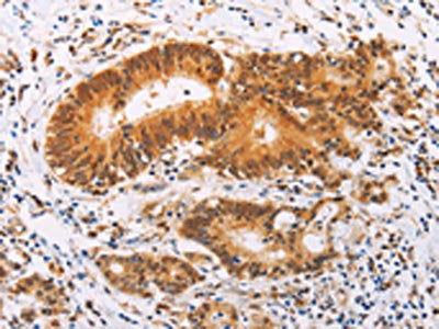 The image on the left is immunohistochemistry of paraffin-embedded Human colon cancer tissue using SRC Antibody(SRC Antibody) at dilution 1/20, on the right is treated with fusion protein. (Original magnification: ×200)Rabbit anti-Human SRC Polyclonal Antibody