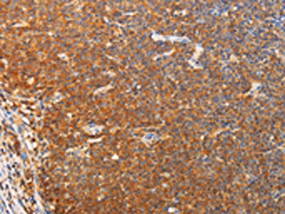 The image on the left is immunohistochemistry of paraffin-embedded Human lymphoma tissue using the antibody Antibody) at dilution 1/20, on the right is treated with fusion protein. (Original magnification: ×200)Rabbit anti-Human SRC Polyclonal Antibody