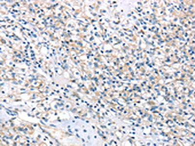 The image on the left is immunohistochemistry of paraffin-embedded Human prostate cancer tissue using HSD11B2 Antibody(HSD11B2 Antibody) at dilution 1/35, on the right is treated with synthetic peptide. (Original magnification: ×200)Rabbit anti-Human HSD11B2 Polyclonal Antibody