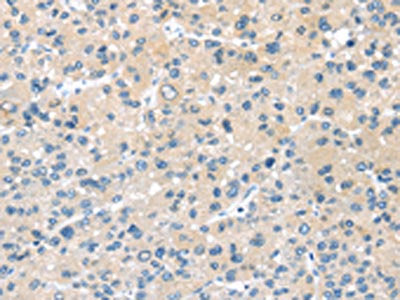 The image on the left is immunohistochemistry of paraffin-embedded Human liver cancer tissue using the antibody Antibody) at dilution 1/35, on the right is treated with synthetic peptide. (Original magnification: ×200)Rabbit anti-Human HSD11B2 Polyclonal Antibody