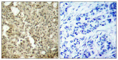 Immunohistochemical analysis of paraffin-embedded human breast carcinoma tissue using PKCd(Ab-645) Antibody(left) or the same antibody preincubated with blocking peptide(right).Rabbit anti-Human PRKCD Polyclonal Antibody