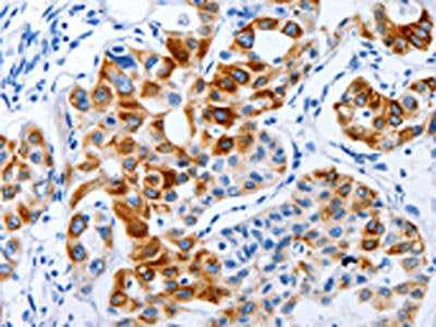 The image on the left is immunohistochemistry of paraffin-embedded Human lung cancer tissue using BPIFB3 Antibody(BPIFB3 Antibody) at dilution 1/120, on the right is treated with synthetic peptide. (Original magnification: ×200)
