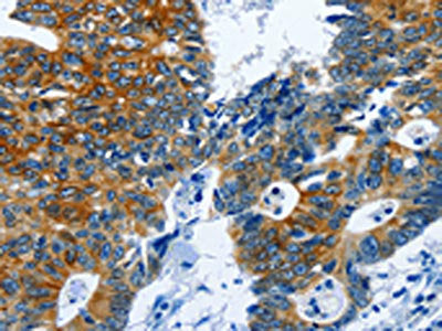 The image on the left is immunohistochemistry of paraffin-embedded Human colon cancer tissue using the antibody Antibody) at dilution 1/120, on the right is treated with synthetic peptide. (Original magnification: ×200)