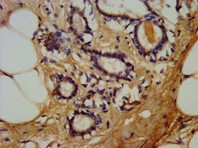 IHC image of the antibody diluted at 1:180 and staining in paraffin-embedded human breast cancer performed on a Leica BondTM system. After dewaxing and hydration, antigen retrieval was mediated by high pressure in a citrate buffer (pH 6.0). Section was blocked with 10% normal goat serum 30min at RT. Then primary antibody (1% BSA) was incubated at 4°C overnight. The primary is detected by a biotinylated secondary antibody and visualized using an HRP conjugated SP system.