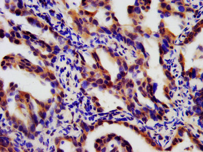 IHC image of LTBR Antibody diluted at 1:180 and staining in paraffin-embedded human lung cancer performed on a Leica BondTM system. After dewaxing and hydration, antigen retrieval was mediated by high pressure in a citrate buffer (pH 6.0). Section was blocked with 10% normal goat serum 30min at RT. Then primary antibody (1% BSA) was incubated at 4°C overnight. The primary is detected by a biotinylated secondary antibody and visualized using an HRP conjugated SP system.