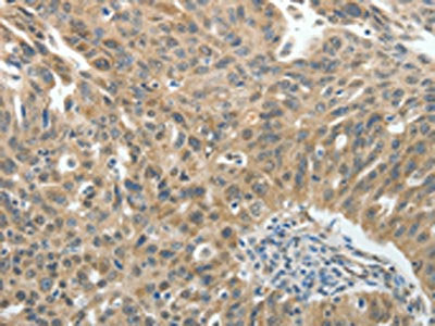 The image on the left is immunohistochemistry of paraffin-embedded Human ovarian cancer tissue using ROCK2 Antibody(ROCK2 Antibody) at dilution 1/20, on the right is treated with fusion protein. (Original magnification: ×200)Rabbit anti-Human ROCK2 Polyclonal Antibody