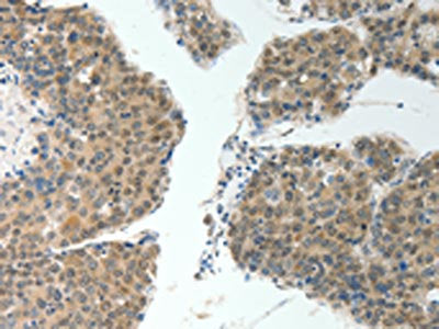 The image on the left is immunohistochemistry of paraffin-embedded Human liver cancer tissue using the antibody Antibody) at dilution 1/20, on the right is treated with fusion protein. (Original magnification: ×200)Rabbit anti-Human ROCK2 Polyclonal Antibody