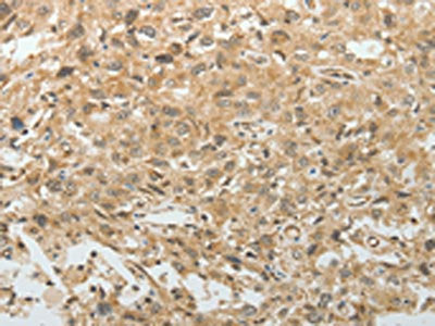 The image on the left is immunohistochemistry of paraffin-embedded Human esophagus cancer tissue using TEKT1 Antibody(TEKT1 Antibody) at dilution 1/30, on the right is treated with fusion protein. (Original magnification: ×200)Rabbit anti-Human TEKT1 Polyclonal Antibody