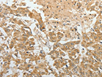 The image on the left is immunohistochemistry of paraffin-embedded Human breast cancer tissue using the antibody Antibody) at dilution 1/30, on the right is treated with fusion protein. (Original magnification: ×200)Rabbit anti-Human TEKT1 Polyclonal Antibody