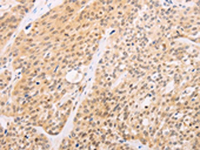 The image on the left is immunohistochemistry of paraffin-embedded Human esophagus cancer tissue using SRC Antibody(SRC Antibody) at dilution 1/10, on the right is treated with fusion protein. (Original magnification: ×200)Rabbit anti-Human SRC Polyclonal Antibody