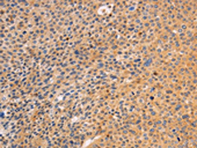 The image on the left is immunohistochemistry of paraffin-embedded Human liver cancer tissue using the antibody Antibody) at dilution 1/10, on the right is treated with fusion protein. (Original magnification: ×200)Rabbit anti-Human SRC Polyclonal Antibody