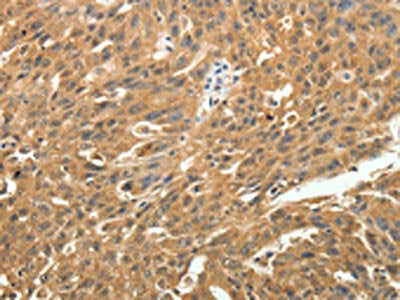 The image on the left is immunohistochemistry of paraffin-embedded Human ovarian cancer tissue using SKP1 Antibody(SKP1 Antibody) at dilution 1/25, on the right is treated with fusion protein. (Original magnification: ×200)Rabbit anti-Human SKP1 Polyclonal Antibody