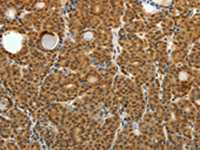 The image on the left is immunohistochemistry of paraffin-embedded Human thyroid cancer tissue using the antibody Antibody) at dilution 1/25, on the right is treated with fusion protein. (Original magnification: ×200)Rabbit anti-Human SKP1 Polyclonal Antibody