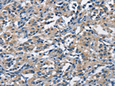 The image on the left is immunohistochemistry of paraffin-embedded Human thyroid cancer tissue using APOL1 Antibody(APOL1 Antibody) at dilution 1/40, on the right is treated with synthetic peptide. (Original magnification: ×200)Rabbit anti-Human APOL1 Polyclonal Antibody