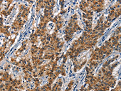 The image on the left is immunohistochemistry of paraffin-embedded Human gastic cancer tissue using the antibody Antibody) at dilution 1/40, on the right is treated with synthetic peptide. (Original magnification: ×200)Rabbit anti-Human APOL1 Polyclonal Antibody