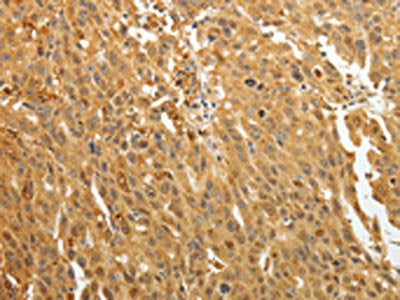 The image on the left is immunohistochemistry of paraffin-embedded Human ovarian cancer tissue using AKR1A1 Antibody(AKR1A1 Antibody) at dilution 1/30, on the right is treated with synthetic peptide. (Original magnification: ×200)Rabbit anti-Human AKR1A1 Polyclonal Antibody