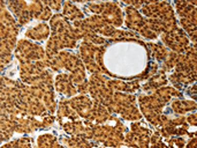 The image on the left is immunohistochemistry of paraffin-embedded Human thyroid cancer tissue using the antibody Antibody) at dilution 1/30, on the right is treated with synthetic peptide. (Original magnification: ×200)Rabbit anti-Human AKR1A1 Polyclonal Antibody