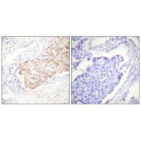 Immunohistochemistry analysis of paraffin-embedded human breast carcinoma tissue using EDD antibody.Rabbit anti-Human UBR5 Polyclonal Antibody