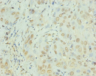 Immunohistochemistry of paraffin-embedded human liver cancer using CXCL8 Antibody at dilution of 1:100Rabbit anti-Human CXCL8 Polyclonal Antibody