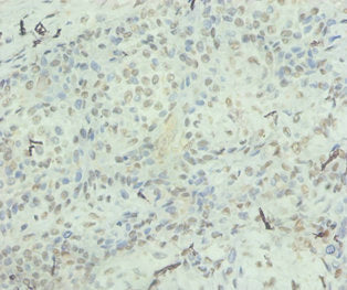 Immunohistochemistry of paraffin-embedded human breast cancer using CXCL8 Antibody at dilution of 1:100Rabbit anti-Human CXCL8 Polyclonal Antibody