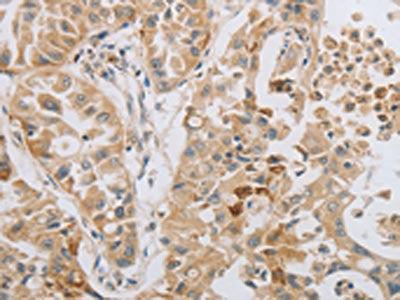 The image on the left is immunohistochemistry of paraffin-embedded Human lung cancer tissue using MAGEB4 Antibody(MAGEB4 Antibody) at dilution 1/50, on the right is treated with fusion protein. (Original magnification: ×200)