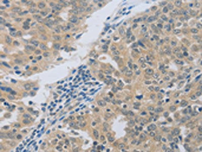 The image on the left is immunohistochemistry of paraffin-embedded Human ovarian cancer tissue using the antibody Antibody) at dilution 1/50, on the right is treated with fusion protein. (Original magnification: ×200)