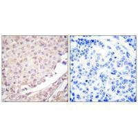 Immunohistochemical analysis of paraffin-embedded human lung carcinoma tissue using Cullin 1 antibody.Rabbit anti-Human CUL1 Polyclonal Antibody