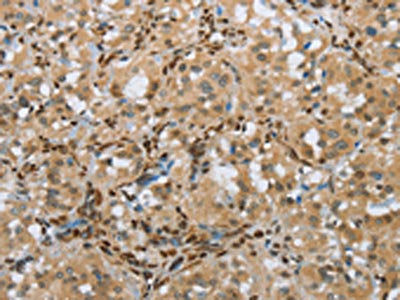The image on the left is immunohistochemistry of paraffin-embedded Human thyroid cancer tissue using FOXE1 Antibody(FOXE1  Antibody) at dilution 1/25, on the right is treated with synthetic peptide. (Original magnification: ×200)Rabbit anti-Human FOXE1 Polyclonal Antibody