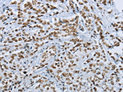 The image on the left is immunohistochemistry of paraffin-embedded Human prostate cancer tissue using the antibody  Antibody) at dilution 1/25, on the right is treated with synthetic peptide. (Original magnification: ×200)Rabbit anti-Human FOXE1 Polyclonal Antibody