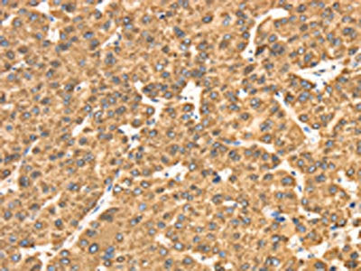 The image on the left is immunohistochemistry of paraffin-embedded Human liver cancer tissue using RRBP1 Antibody(RRBP1 Antibody) at dilution 1/25, on the right is treated with fusion protein. (Original magnification: ×200)Rabbit anti-Human RRBP1 Polyclonal Antibody