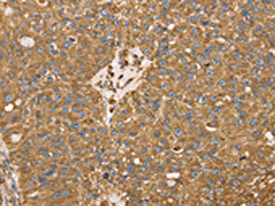 The image on the left is immunohistochemistry of paraffin-embedded Human breast cancer tissue using the antibody Antibody) at dilution 1/25, on the right is treated with fusion protein. (Original magnification: ×200)Rabbit anti-Human RRBP1 Polyclonal Antibody