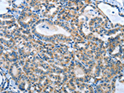 The image on the left is immunohistochemistry of paraffin-embedded Human thyroid cancer tissue using ANGPT2 Antibody(ANGPT2 Antibody) at dilution 1/45, on the right is treated with fusion protein. (Original magnification: ×200)Rabbit anti-Human ANGPT2 Polyclonal Antibody