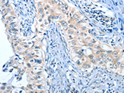 The image on the left is immunohistochemistry of paraffin-embedded Human cervical cancer tissue using the antibody Antibody) at dilution 1/45, on the right is treated with fusion protein. (Original magnification: ×200)Rabbit anti-Human ANGPT2 Polyclonal Antibody