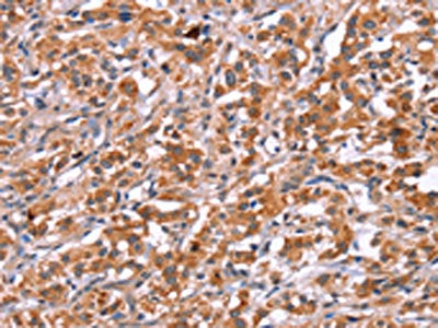 The image on the left is immunohistochemistry of paraffin-embedded Human thyroid cancer tissue using the antibody Antibody) at dilution 1/25, on the right is treated with synthetic peptide. (Original magnification: ×200)Rabbit anti-Human ICAM5 Polyclonal Antibody