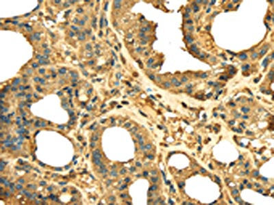 The image on the left is immunohistochemistry of paraffin-embedded Human thyroid cancer tissue using RPS3 Antibody(RPS3 Antibody) at dilution 1/25, on the right is treated with fusion protein. (Original magnification: ×200)Rabbit anti-Human RPS3 Polyclonal Antibody