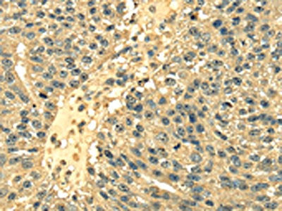 The image on the left is immunohistochemistry of paraffin-embedded Human breast cancer tissue using the antibody Antibody) at dilution 1/25, on the right is treated with fusion protein. (Original magnification: ×200)Rabbit anti-Human RPS3 Polyclonal Antibody