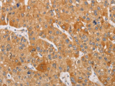 The image on the left is immunohistochemistry of paraffin-embedded Human liver cancer tissue using BNIP3 Antibody(BNIP3 Antibody) at dilution 1/20, on the right is treated with fusion protein. (Original magnification: ×200)