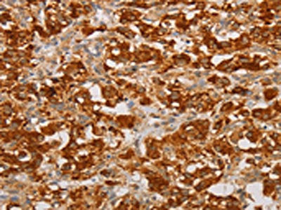 The image on the left is immunohistochemistry of paraffin-embedded Human thyroid cancer tissue using the antibody Antibody) at dilution 1/20, on the right is treated with fusion protein. (Original magnification: ×200)
