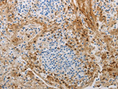 The image on the left is immunohistochemistry of paraffin-embedded Human tonsil tissue using NGFR Antibody(NGFR Antibody) at dilution 1/50, on the right is treated with synthetic peptide. (Original magnification: ×200)Rabbit anti-Human NGFR Polyclonal Antibody