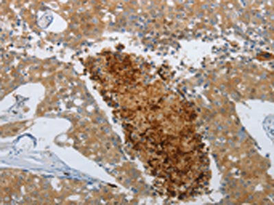 The image on the left is immunohistochemistry of paraffin-embedded Human breast cancer tissue using the antibody Antibody) at dilution 1/50, on the right is treated with synthetic peptide. (Original magnification: ×200)Rabbit anti-Human NGFR Polyclonal Antibody