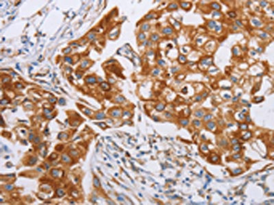The image on the left is immunohistochemistry of paraffin-embedded Human breast cancer tissue using CDC27 Antibody(CDC27 Antibody) at dilution 1/20, on the right is treated with synthetic peptide. (Original magnification: ×200)Rabbit anti-Human CDC27 Polyclonal Antibody