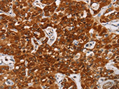 The image on the left is immunohistochemistry of paraffin-embedded Human lung cancer tissue using the antibody Antibody) at dilution 1/20, on the right is treated with synthetic peptide. (Original magnification: ×200)Rabbit anti-Human CDC27 Polyclonal Antibody