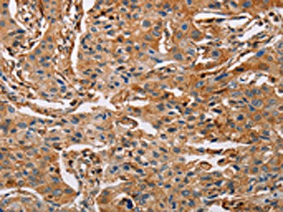 The image on the left is immunohistochemistry of paraffin-embedded Human lung cancer tissue using ACTA1 Antibody(ACTA1 Antibody) at dilution 1/65, on the right is treated with fusion protein. (Original magnification: ×200)